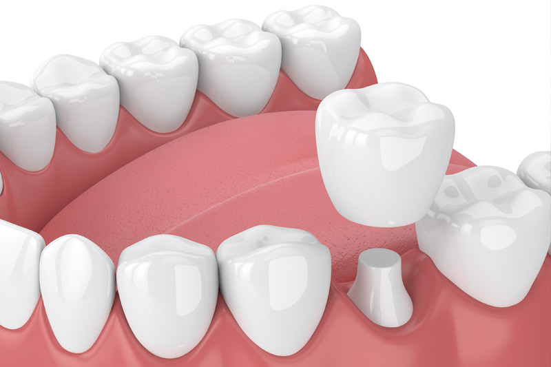 Dental Crowns in Livonia