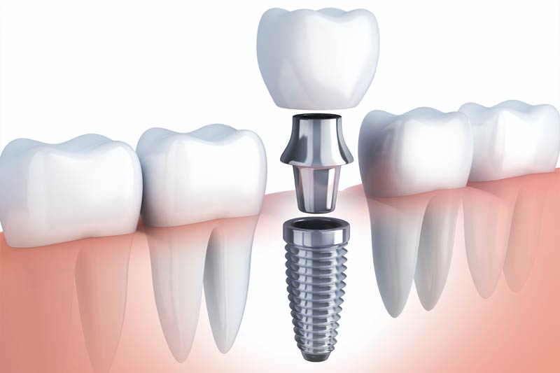 Single Tooth Dental Implants in Livonia