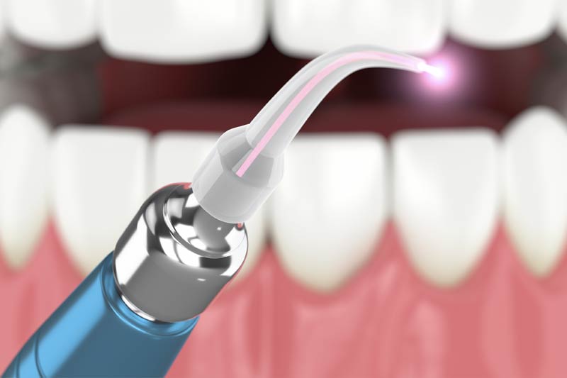 Laser Dentistry in Livonia