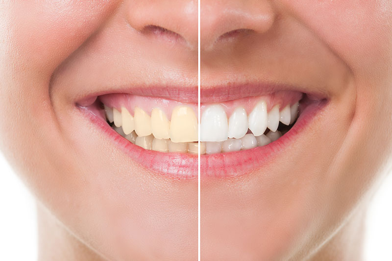 Teeth Whitening in Livonia