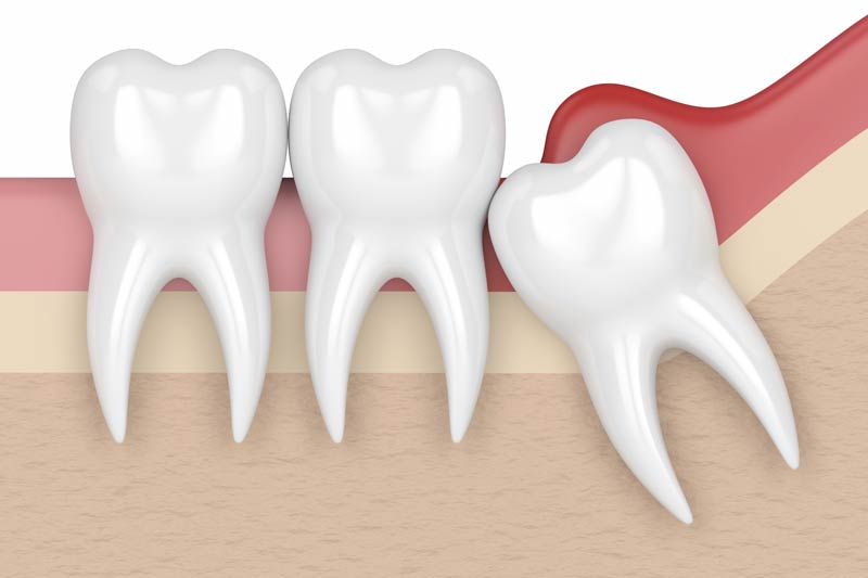 Wisdom Tooth Removal in Livonia